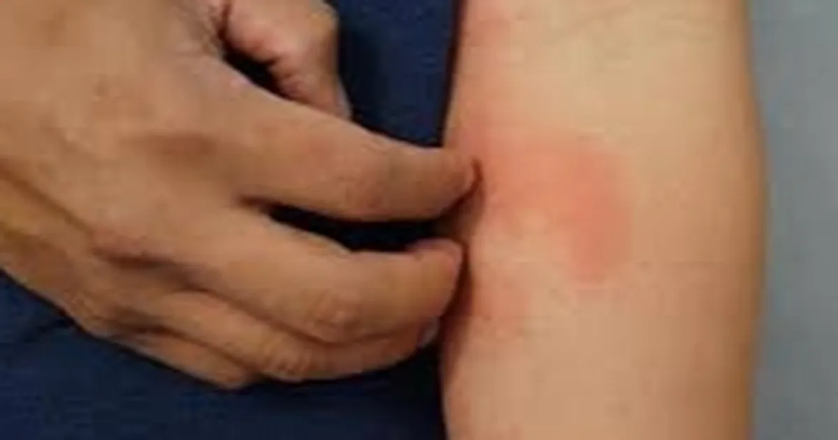 T-rk-Dermatoloji-Derne-i-nden-Uyuz-a-klamas